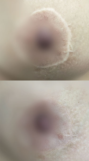 pecho de mujer con micropigmentacion